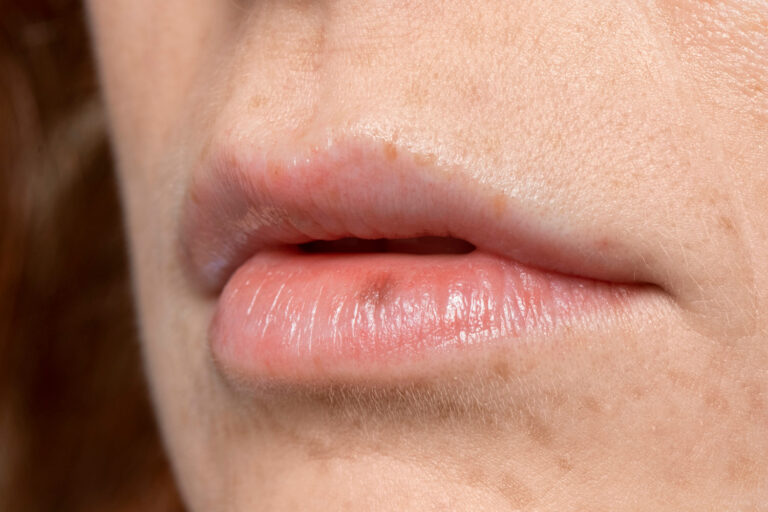 How soon after kissing someone with a cold sore will you get one?